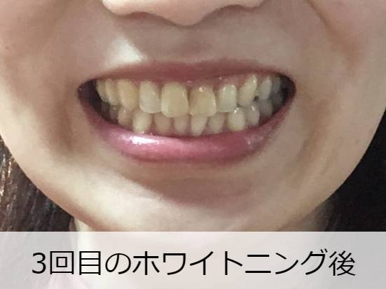 スパークリングイレーサー3回目完了 スパークリングイレーサー3回目完了